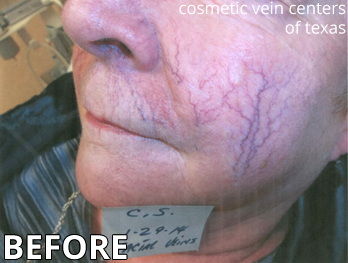 Woman Before Facial Vein Treatment